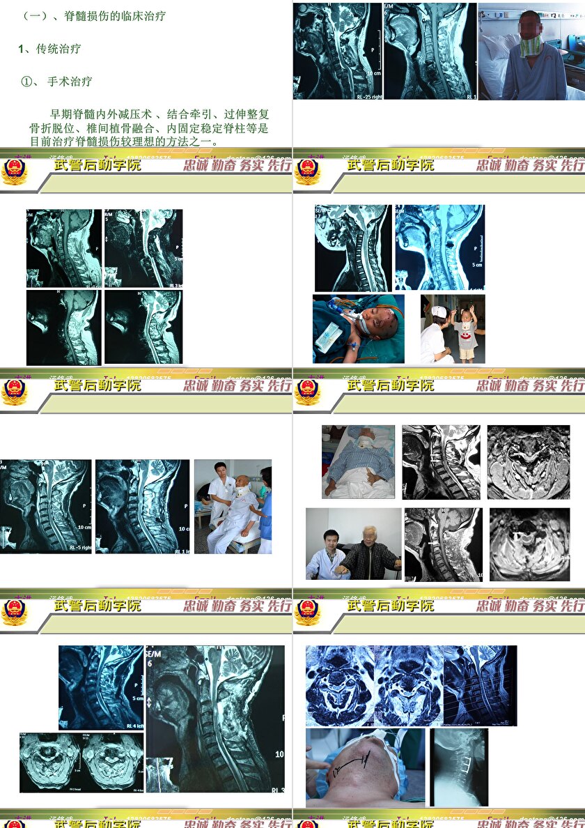 2023年脊髓損傷研究新進展，里程碑式的突破與日常奇妙變化