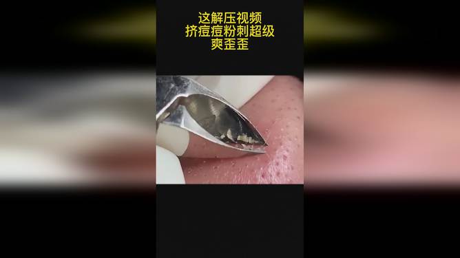 最新擠膿包視頻，見證變化的力量，自信與成就感的誕生之地